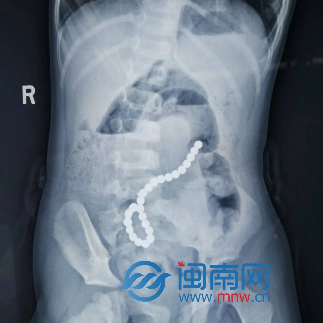 泉州:2岁多男孩吞了24颗磁力珠,胃肠十几处穿孔_异物