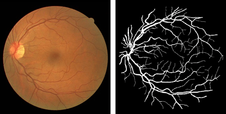 南开大学提速眼底图像ai分析采用fpga开源框架浪潮tf2