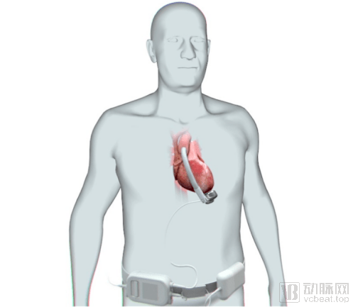累計融資金額超5億元corwave如何利用創新技術打造心臟輔助設備
