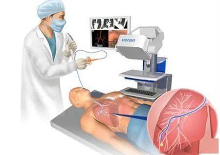 话科普丨心胸外科副主任乔峰带您了解什么是支气管镜检查!