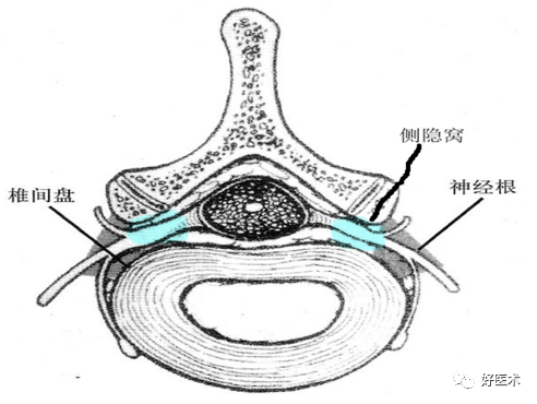 结合ct及图解看部分椎间盘病变:椎间盘向旁突出,未压迫脊髓,但侧隐窝