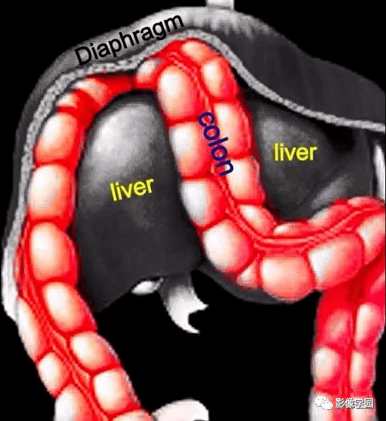 间位结肠综合征chilaiditi综合征