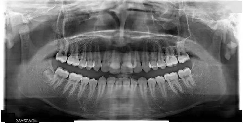 王xx 20210130 多生牙cbct 137xxxx6215