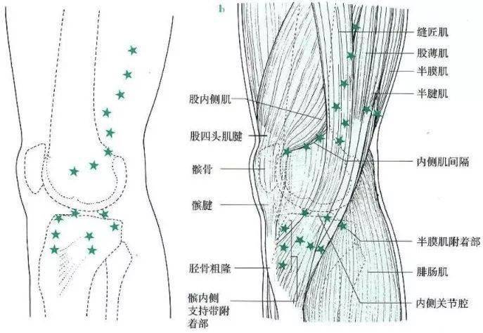 腘动脉挤压综合征后侧:髋关节疾病引发膝内侧痛(闭孔神经支配 无