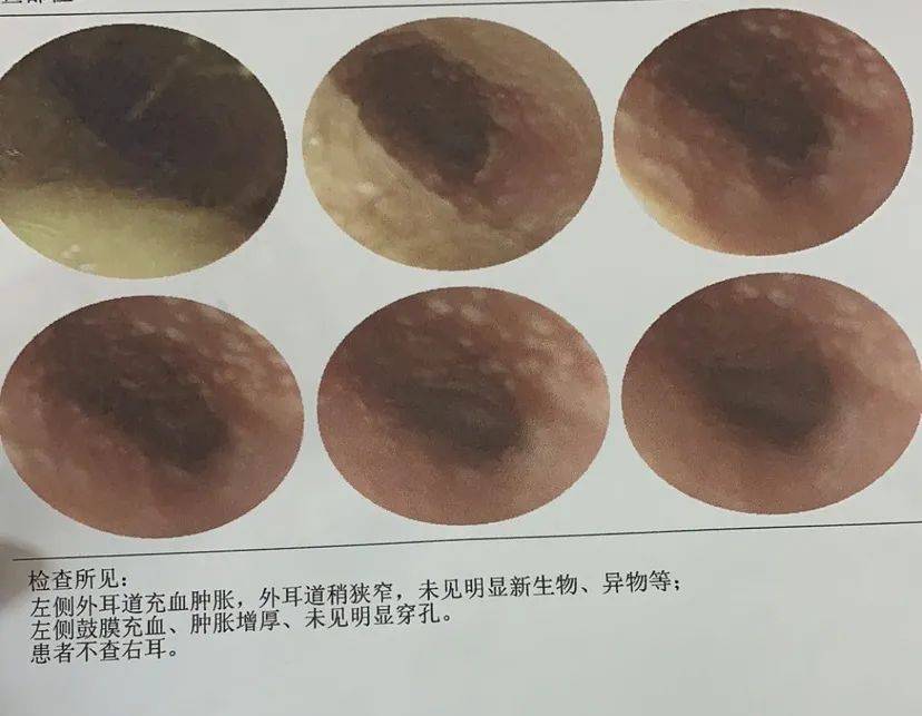 一直採耳一直爽小心感染hpv