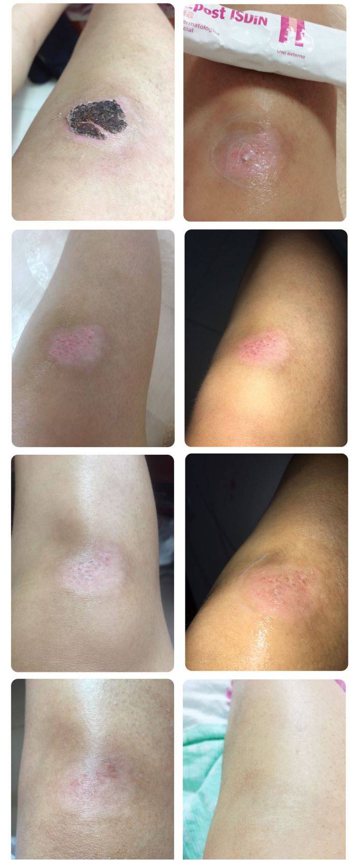 产后疤痕增生像一条长虫怎么护理才能避免
