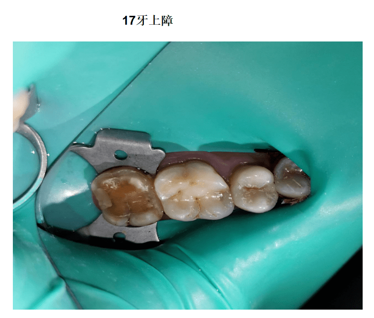 【病例】上颌第二恒磨牙大面积磨耗emax瓷嵌体微创修复