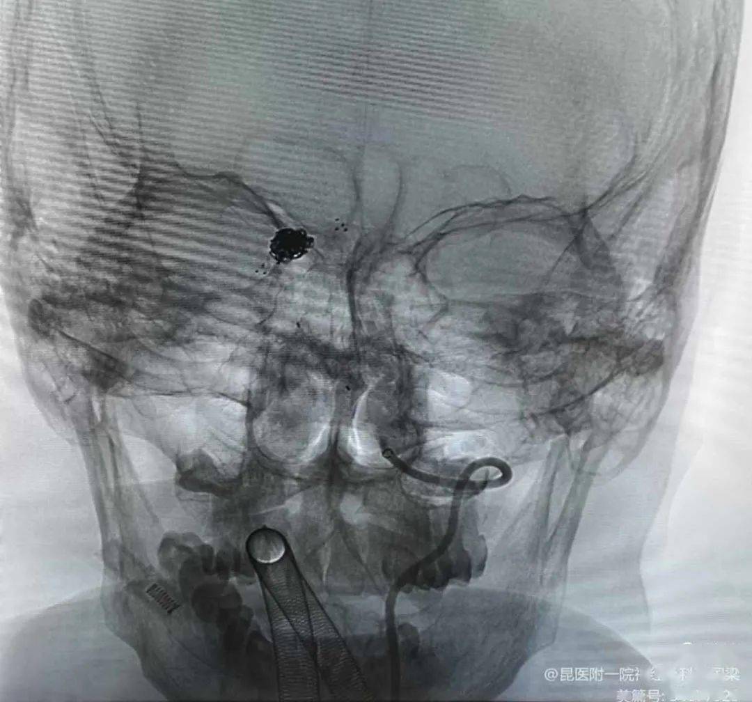 术后的正,侧位相.术后第二天复查头颅ct未见出血及脑梗.