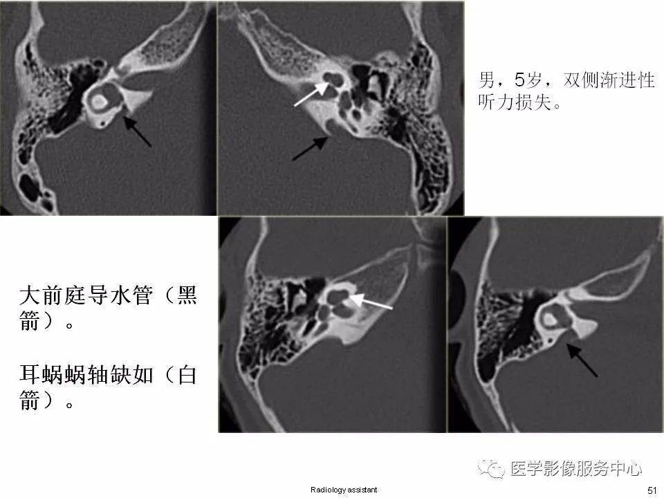 主要基于mri第二部分:内耳畸形分类,主要基于ct第一部分:耳蜗解剖