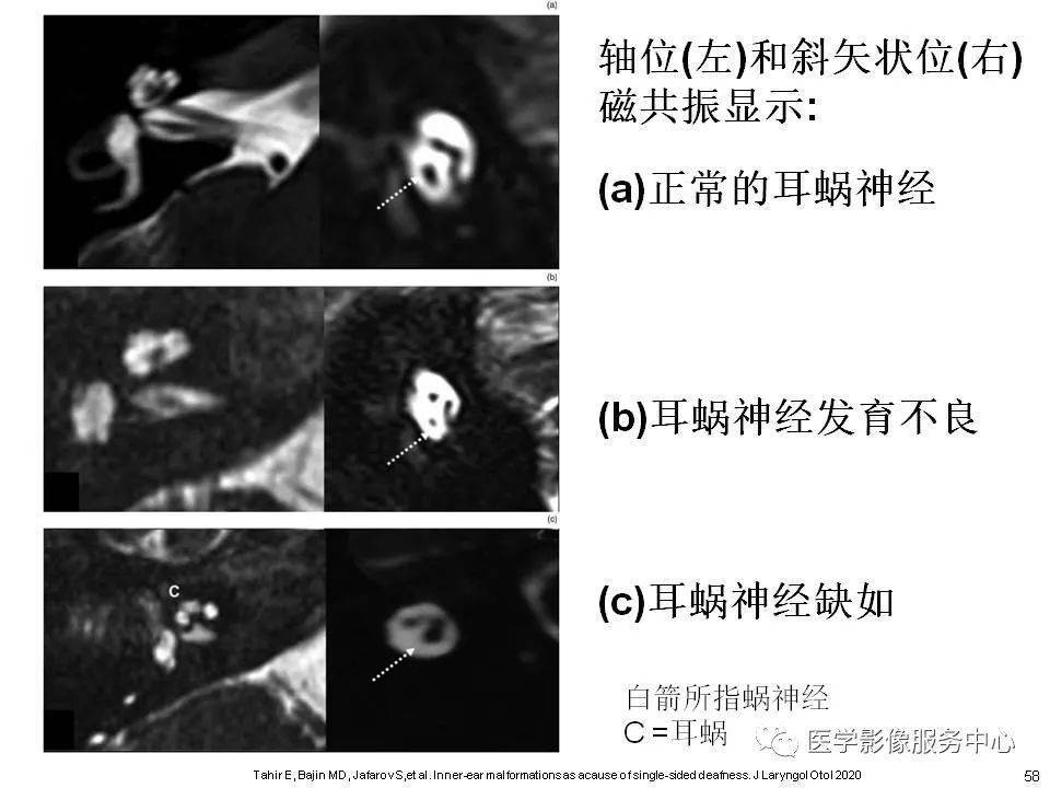 內耳正常解剖及畸形分類