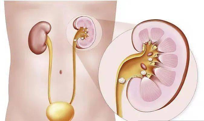 不要因為一個小石頭,丟了寶貴的腎臟!_輸尿管