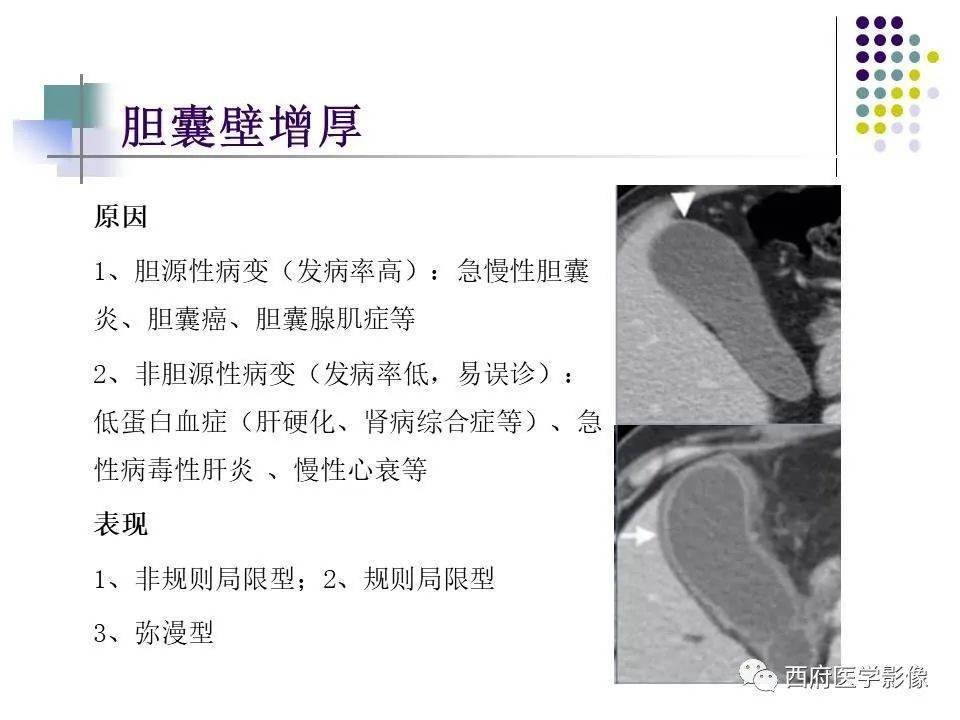 推荐丨黄色肉芽肿性胆囊炎的影像诊断
