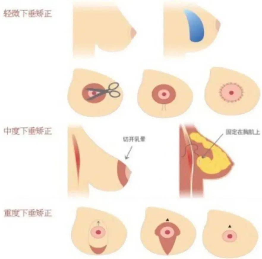 乳房发育阶段图解真实图片