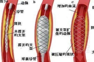 供氧,缓解和消除心绞痛的症状,也就是常说的"冠状动脉搭桥"手术