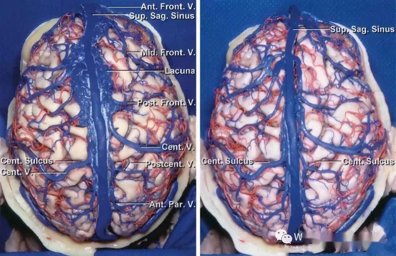 深刻理解矢状窦旁静脉的解剖对安全进行开颅手术至关重要.