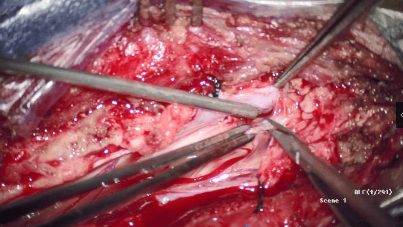 病例分享齐鲁医院江玉泉教授团队脊髓纵裂畸形手术病例分享