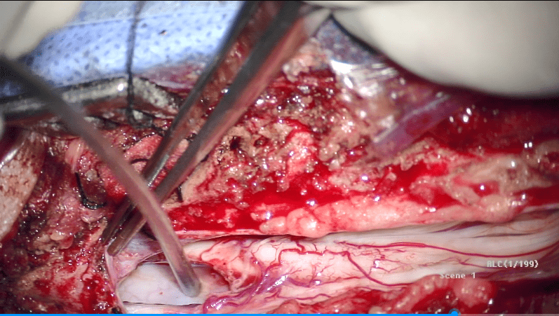 病例分享齐鲁医院江玉泉教授团队脊髓纵裂畸形手术病例分享