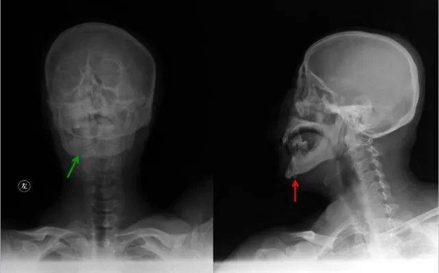 骨科影像急诊最可能会遇到的100张图像