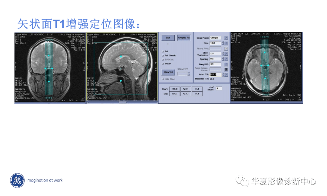 工作必備丨磁共振規範化掃描方案30t垂體