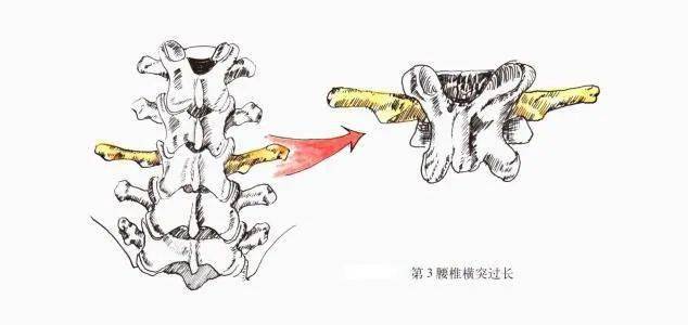 壓力最大,而l3橫突最長,最寬,尖端肥厚;附著在l3橫突的胸腰筋膜前層也