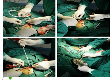 b超定位下经皮穿刺腹透置管术