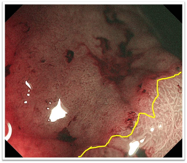 nbi menbi me及eus精查四胃体下部大弯侧 2-3 cm 黏膜色泽改变胃镜