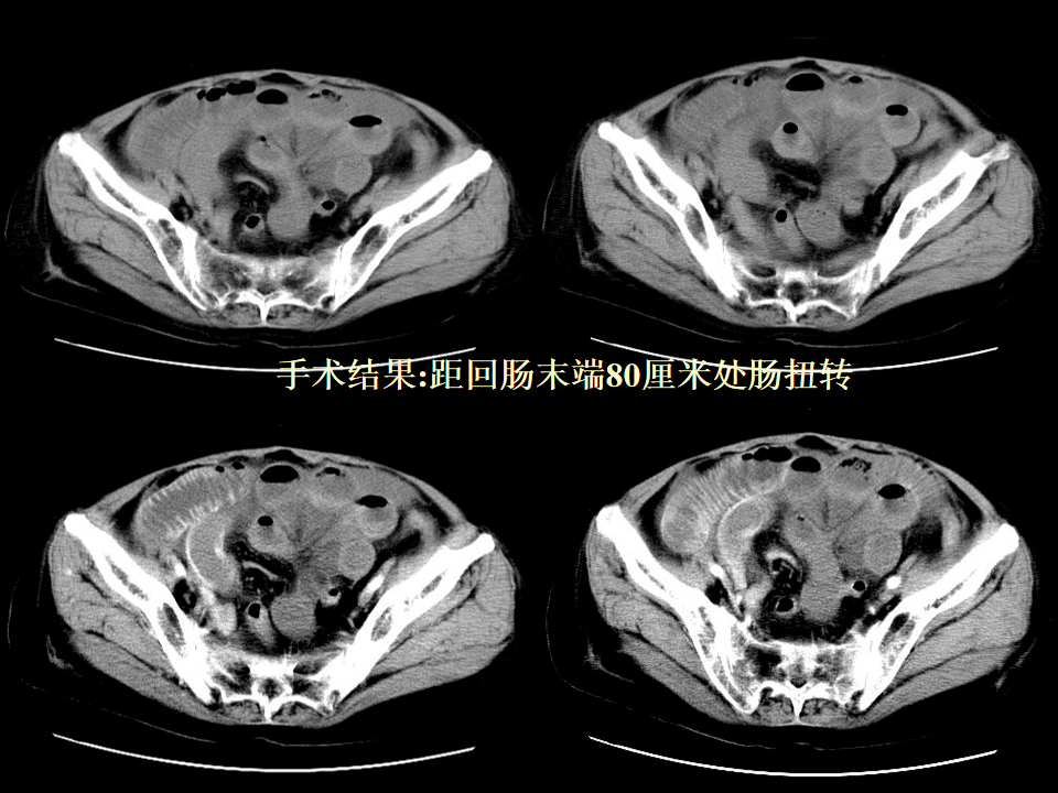 ct入门 肠梗阻的ct影像诊断_医学