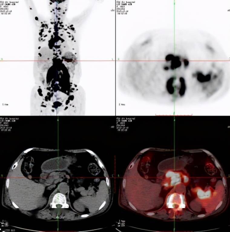 pet-ct是将pet扫描仪和螺旋ct设备结合在一起形成的功能显像仪器