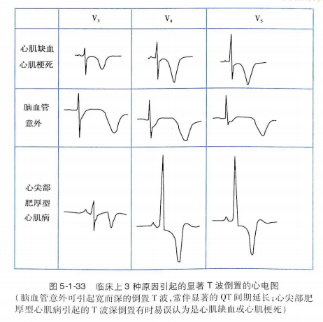 除冠心病外,其他疾病如心肌病心肌炎,瓣膜病,心包炎,腦血管意外(尤其