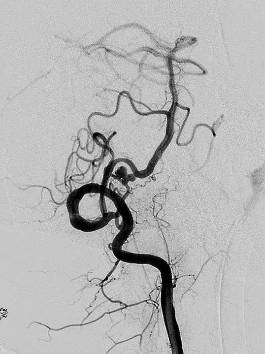atlas病例集丨姜長春遊刃有餘atlas支架輔助栓塞纖細椎動脈動脈瘤