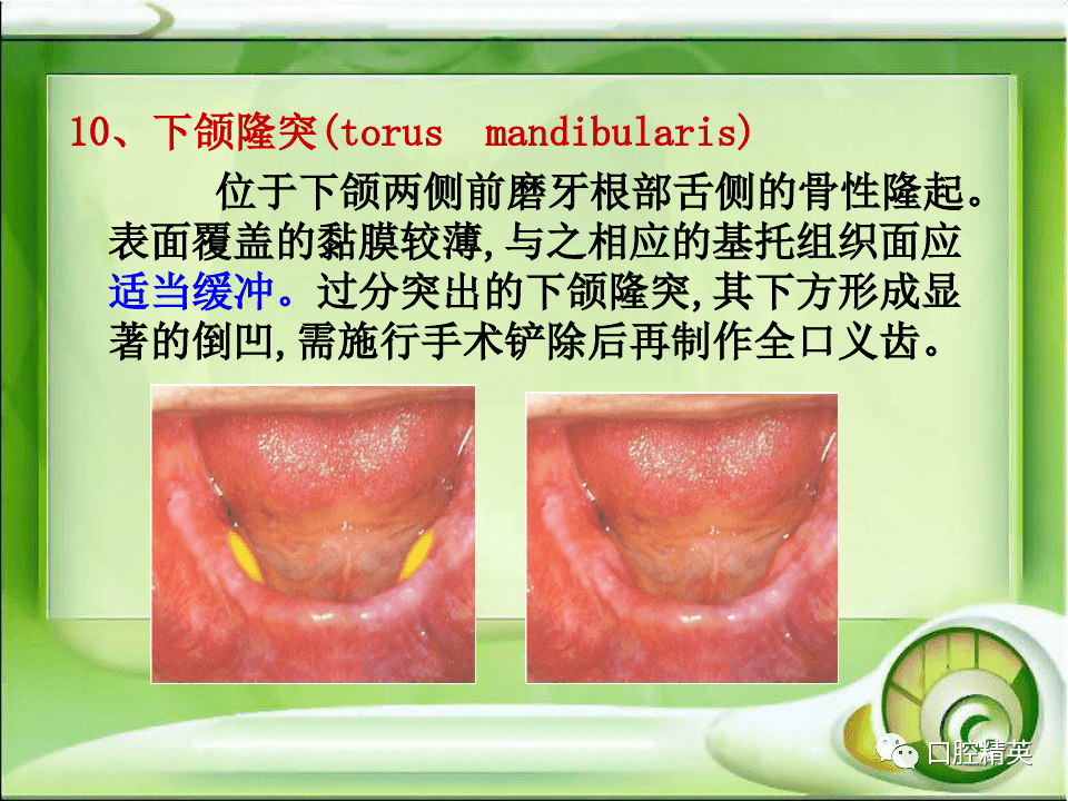 全口无牙颌解剖标志识别