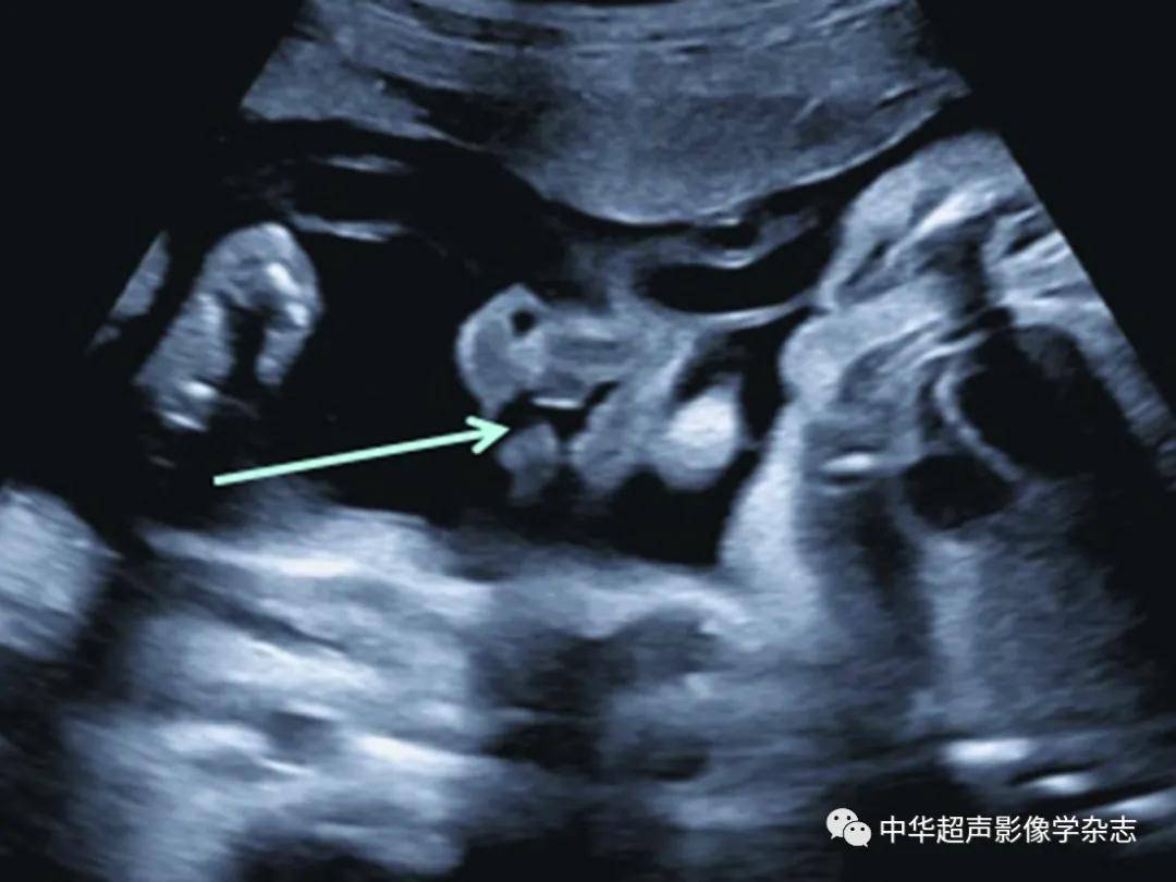 24周胎儿B超图图片