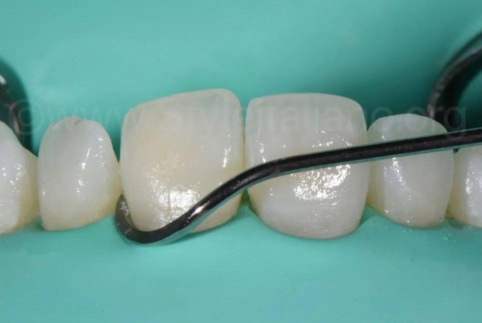 牙医学堂树脂渗透酸蚀终止的时机把握