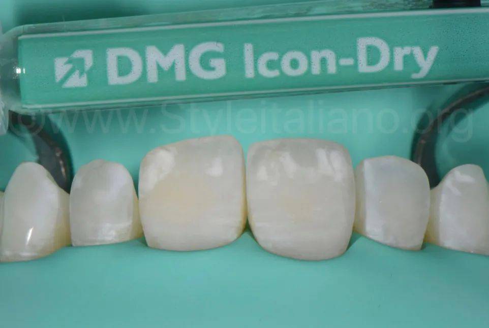 牙医学堂树脂渗透酸蚀终止的时机把握