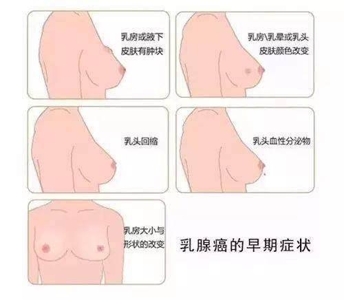 注意 腋窝 肩颈痛是乳房病变的先兆