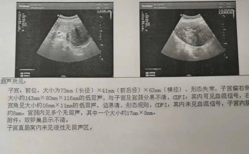 正常子宫b超报告单图片