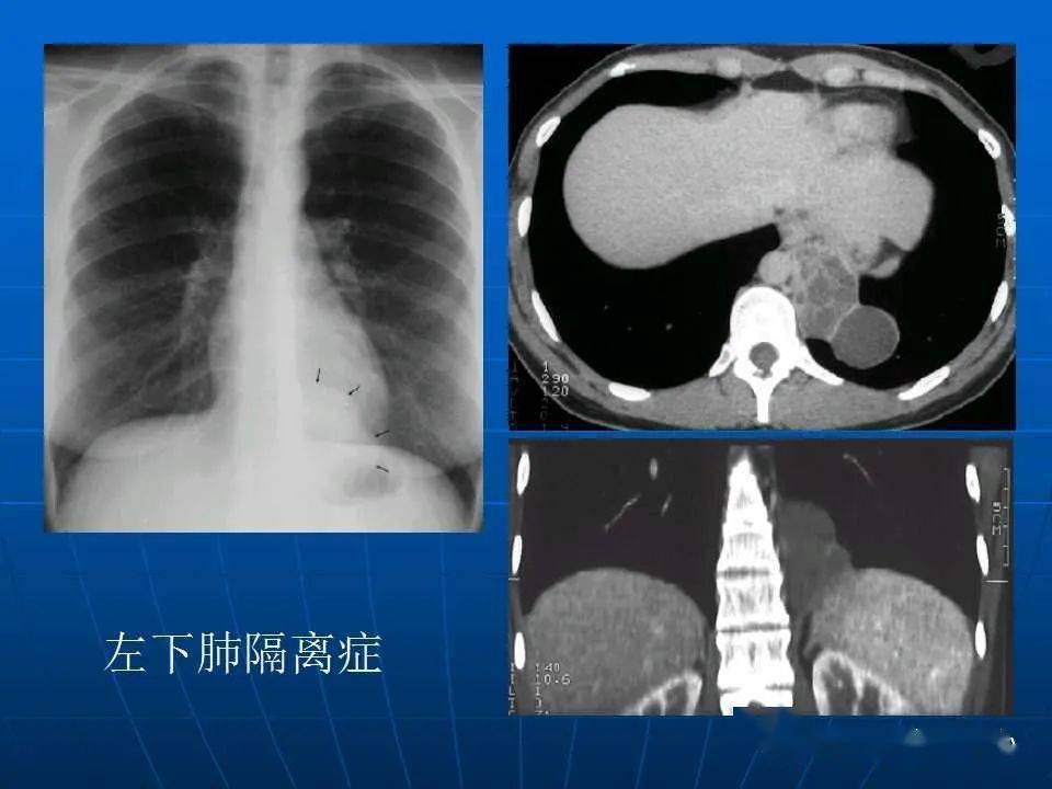 肺隔离症影像表现