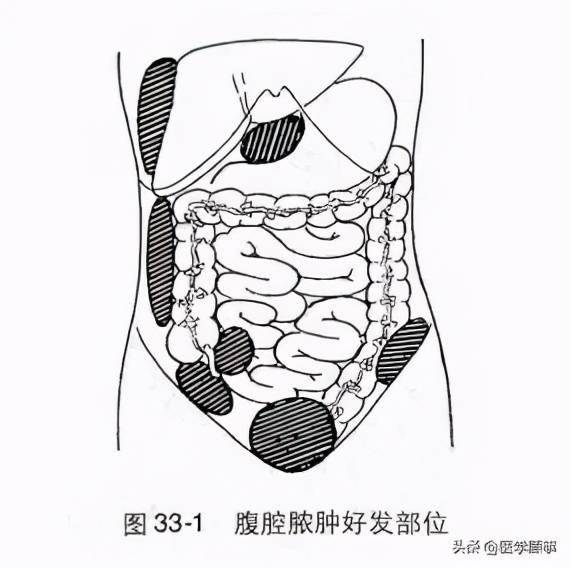 腹腔脓肿可分为膈下脓肿,盆腔脓肿和肠间脓肿(图33-1.