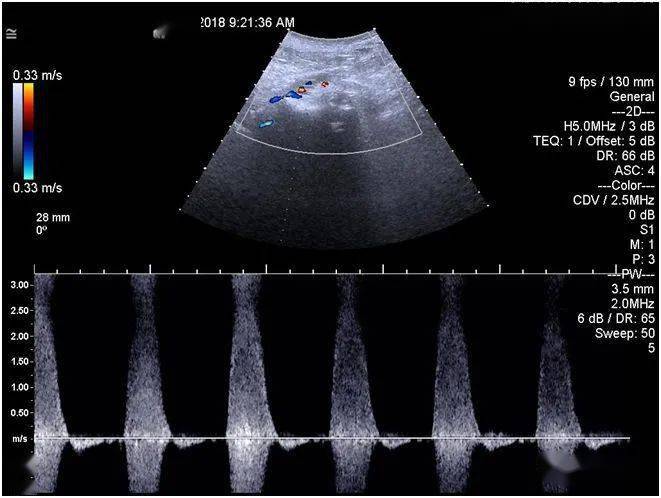 示左侧髂外动脉血流加速,呈湍流图 4 pw 示右侧股总动脉呈三相波图 3