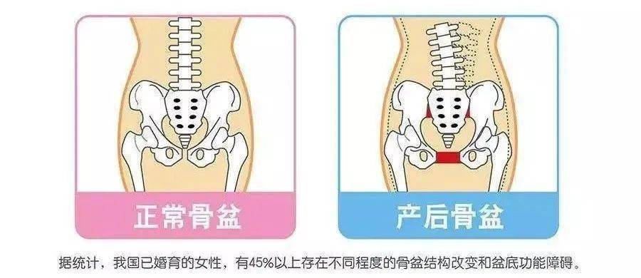 生完宝宝想要蜜桃臀你做盆骨修复了吗