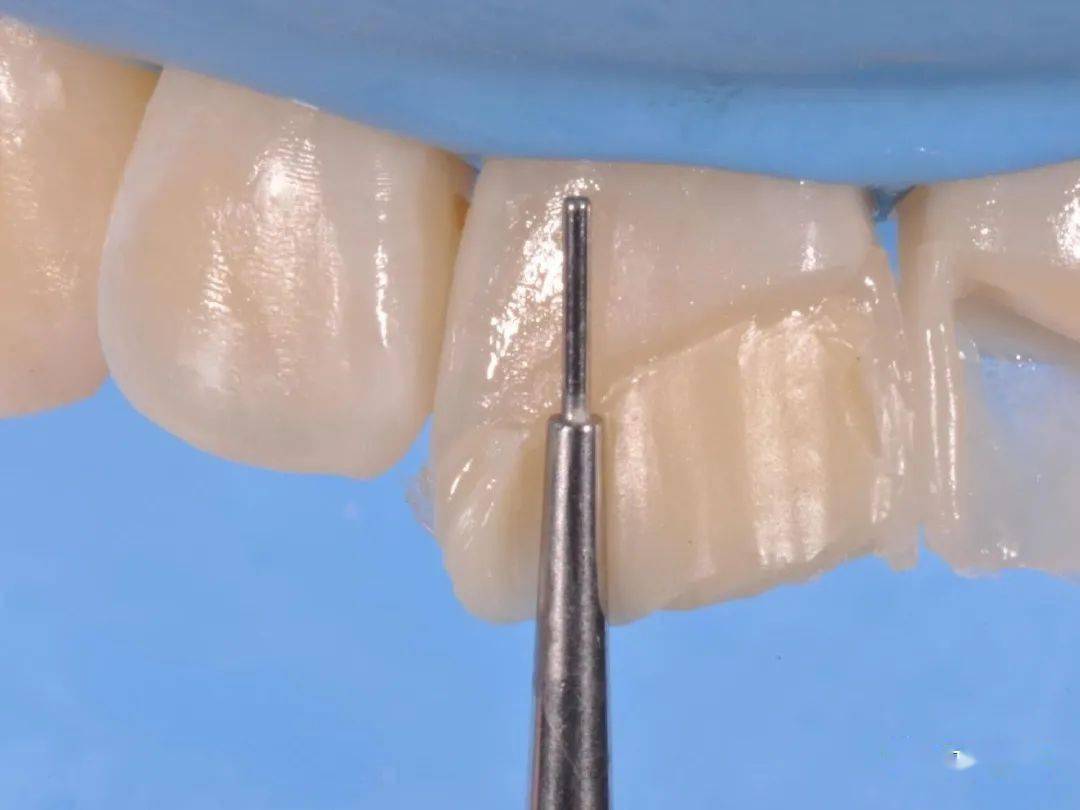 3m树脂微创美学修复