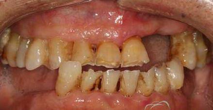 科普百科今日科普牙齿与香烟的爱恨情仇