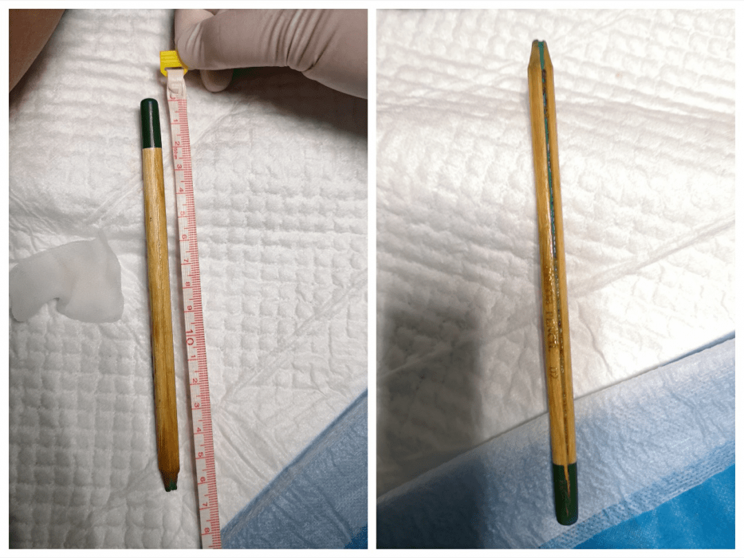 温州12岁男孩将16cm长的铅笔塞进肛门 异物