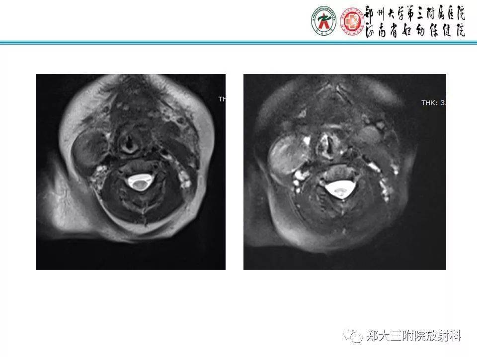 结节性筋膜炎影像表现