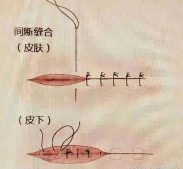 身邊事拆線沒拆乾淨醫生說這個鍋我不背