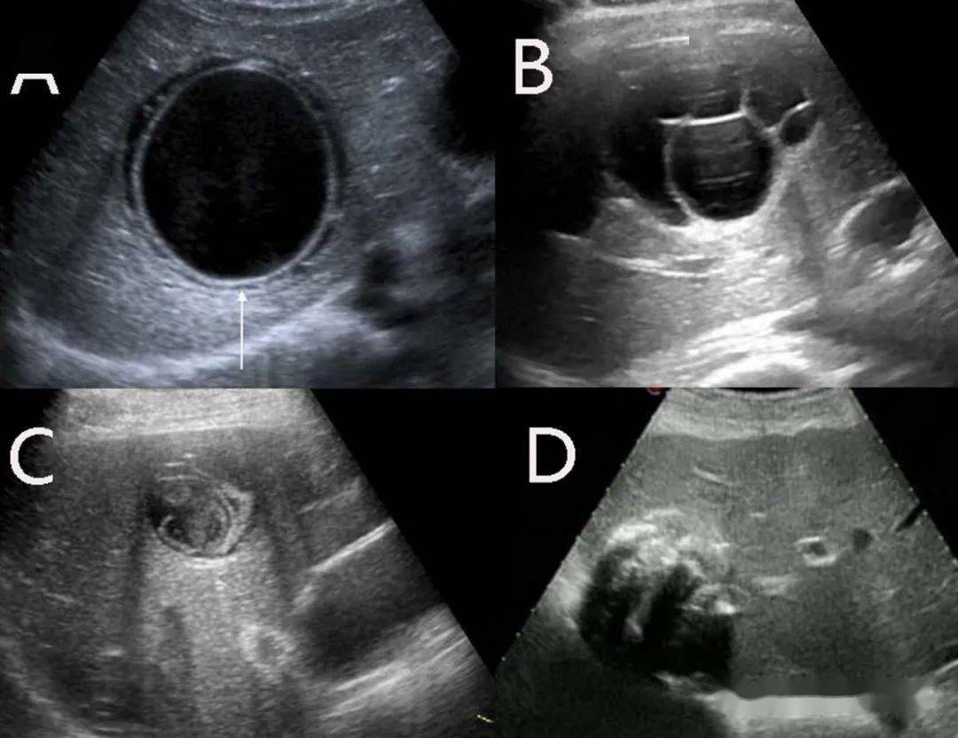 肝脏常见囊性病变的超声诊断与鉴别状