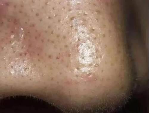 怎么解决毛孔粗大的问题 58d8eabb6bbb41308081cc580bda0191.jpeg