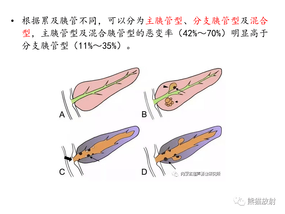 胰管型ipmn图片