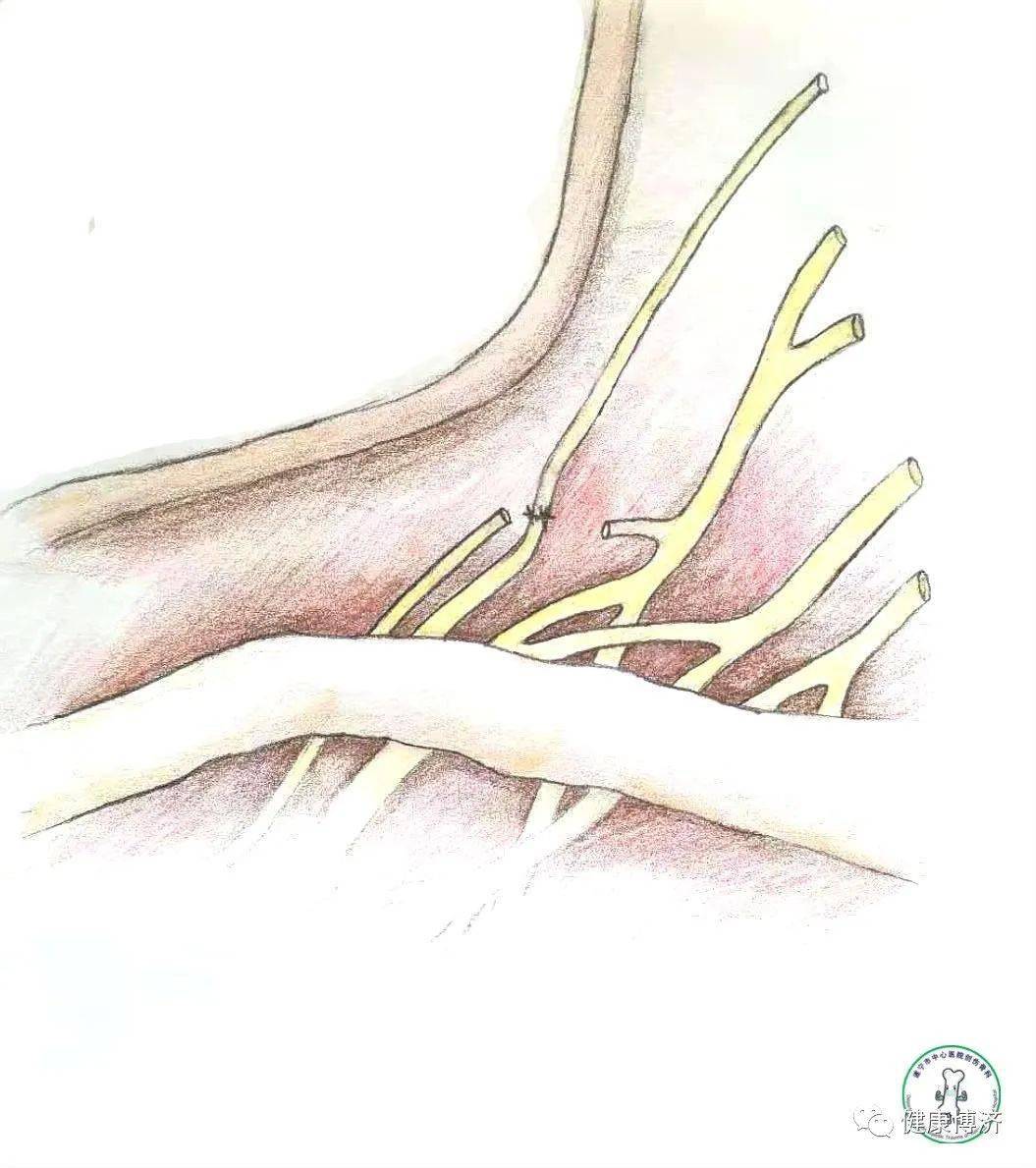 副神经转位于肩胛上神经第3-8肋间神经转位于肌皮神经及正中神经外侧