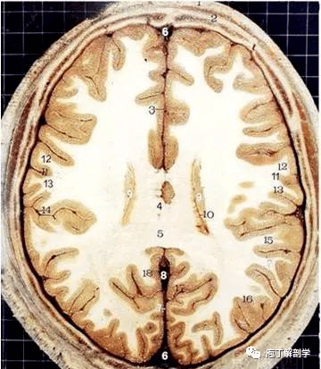 經典大體顱腦斷層解剖圖橫斷面